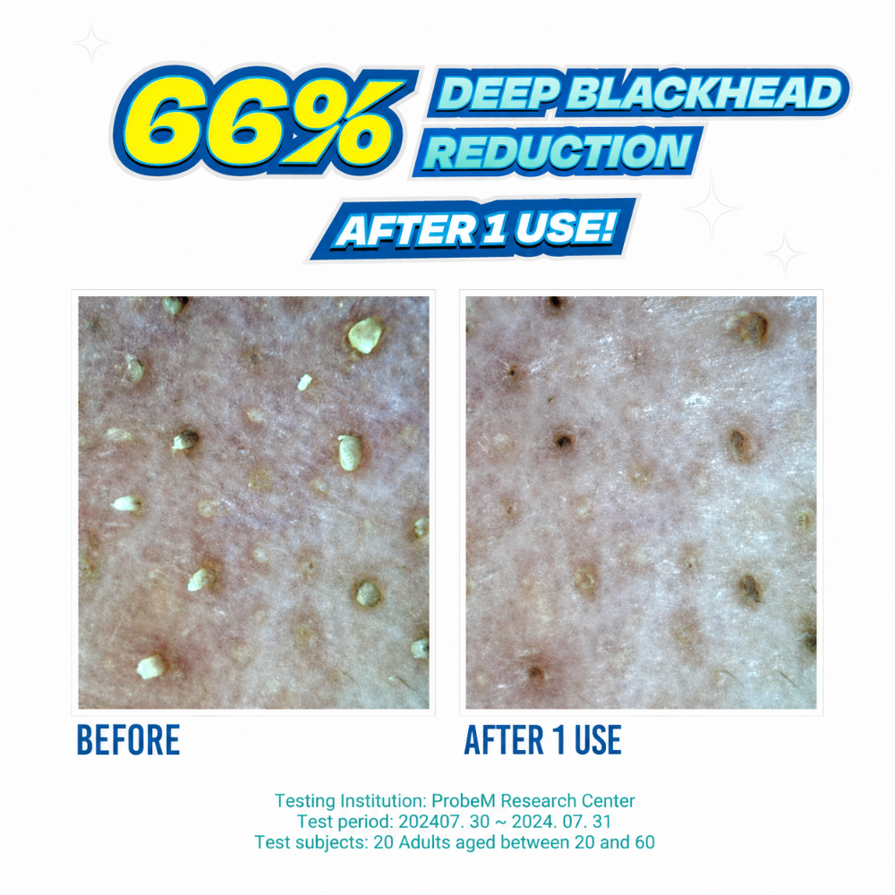 Jumiso Blackhead Melting Softener Special Kit (150ml)